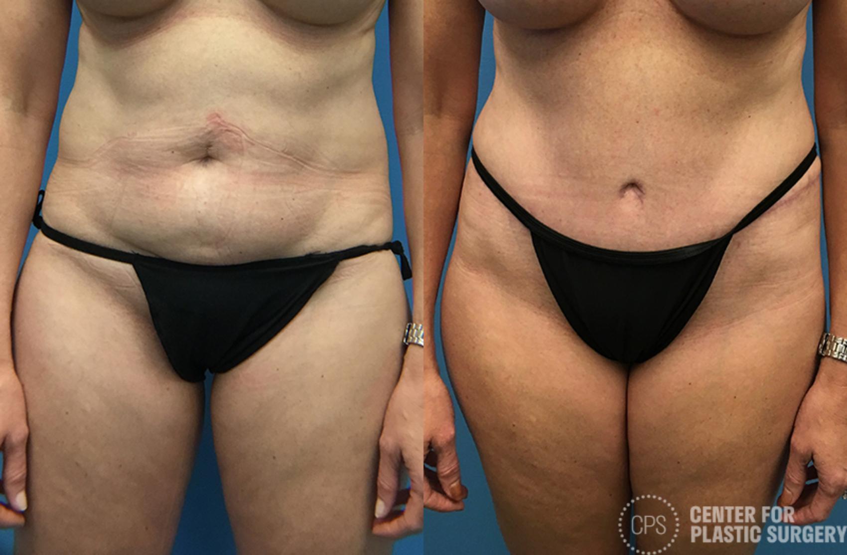 Tummy Tuck Case 46 Before & After Front | Washington DC, Bethesda & Chevy Chase, Washington D.C. Metropolitan Area | Center for Plastic Surgery