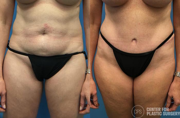 Tummy Tuck Case 46 Before & After Front | Chevy Chase & Annandale, Washington D.C. Metropolitan Area | Center for Plastic Surgery