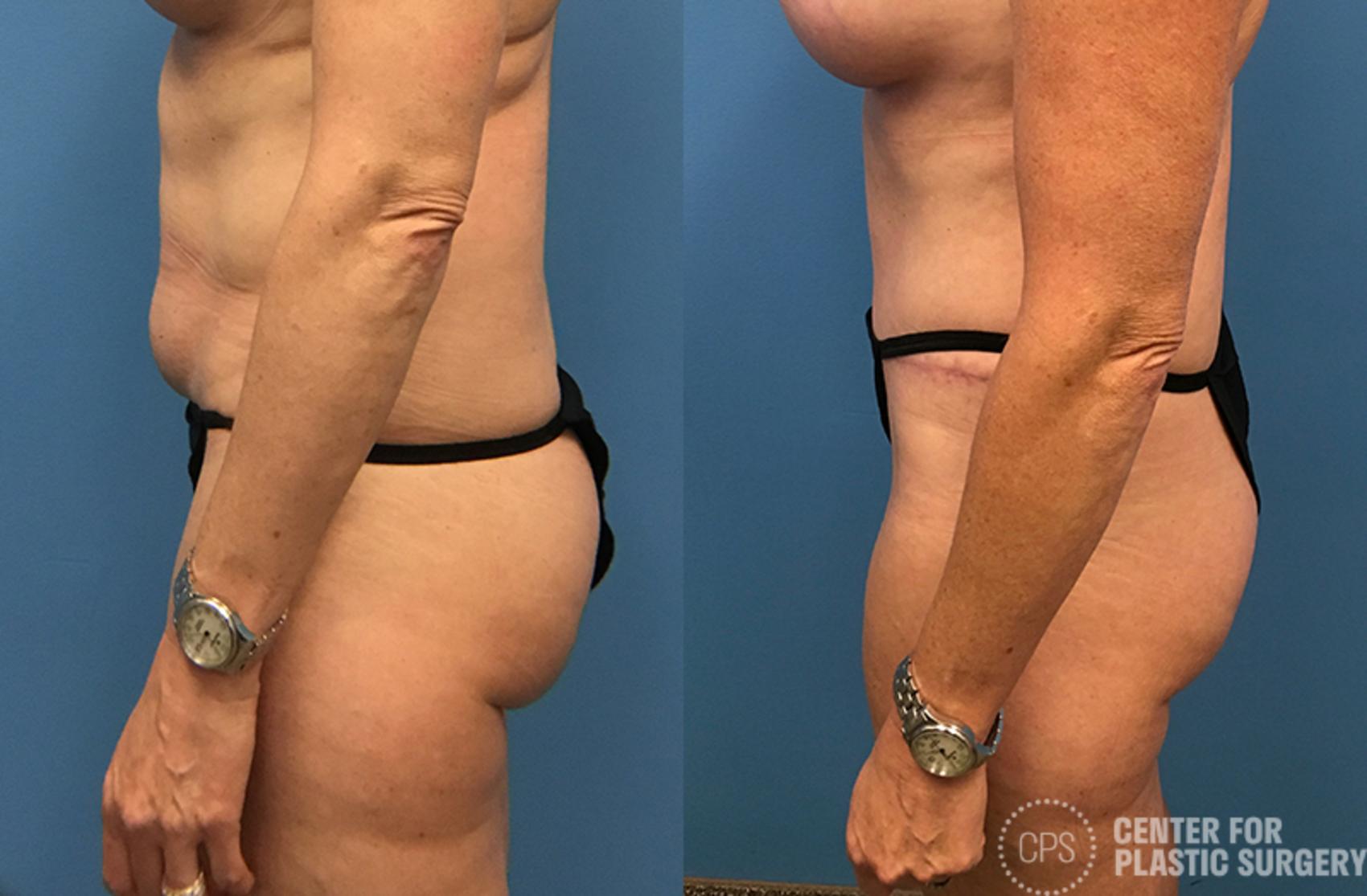 Tummy Tuck Case 46 Before & After Left Side | Annandale, Washington D.C. Metropolitan Area | Center for Plastic Surgery