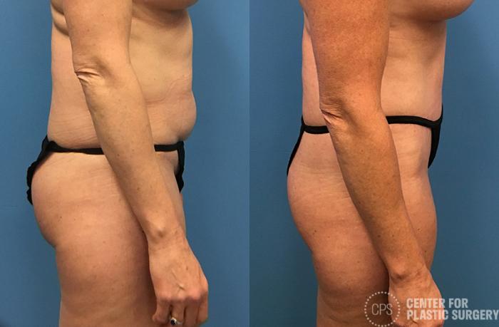Liposuction Case 46 Before & After Right Side | Chevy Chase & Annandale, Washington D.C. Metropolitan Area | Center for Plastic Surgery