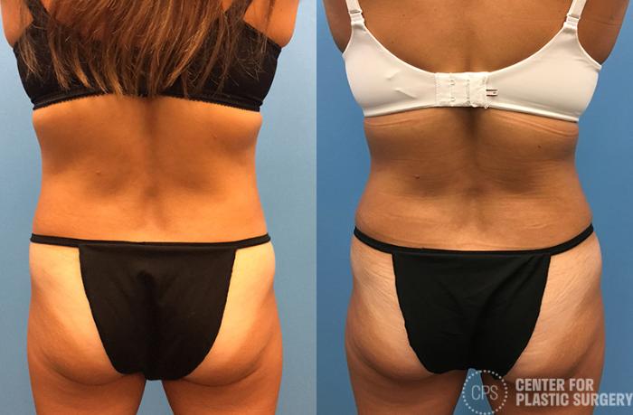 Tummy Tuck Case 47 Before & After Back | Chevy Chase & Annandale, Washington D.C. Metropolitan Area | Center for Plastic Surgery