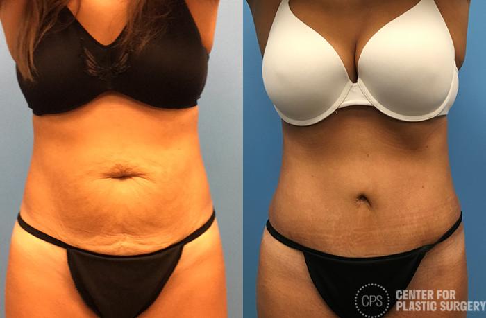 Tummy Tuck Case 47 Before & After Front | Chevy Chase & Annandale, Washington D.C. Metropolitan Area | Center for Plastic Surgery