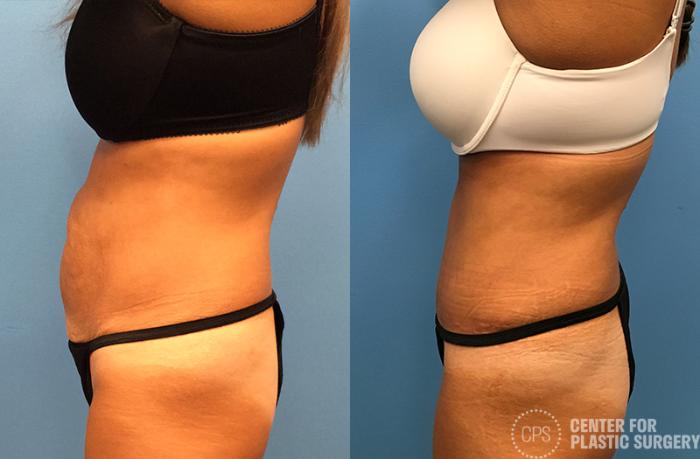 Tummy Tuck Case 47 Before & After Left Side | Chevy Chase & Annandale, Washington D.C. Metropolitan Area | Center for Plastic Surgery