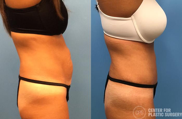 Tummy Tuck Case 47 Before & After Right Side | Chevy Chase & Annandale, Washington D.C. Metropolitan Area | Center for Plastic Surgery