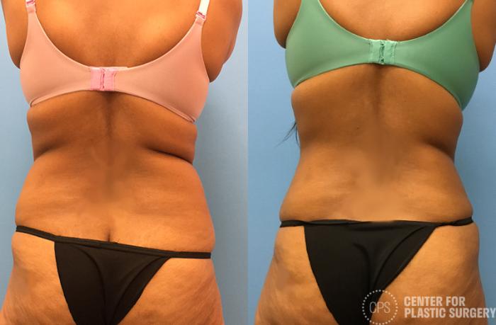 Tummy Tuck Case 48 Before & After Back | Chevy Chase & Annandale, Washington D.C. Metropolitan Area | Center for Plastic Surgery