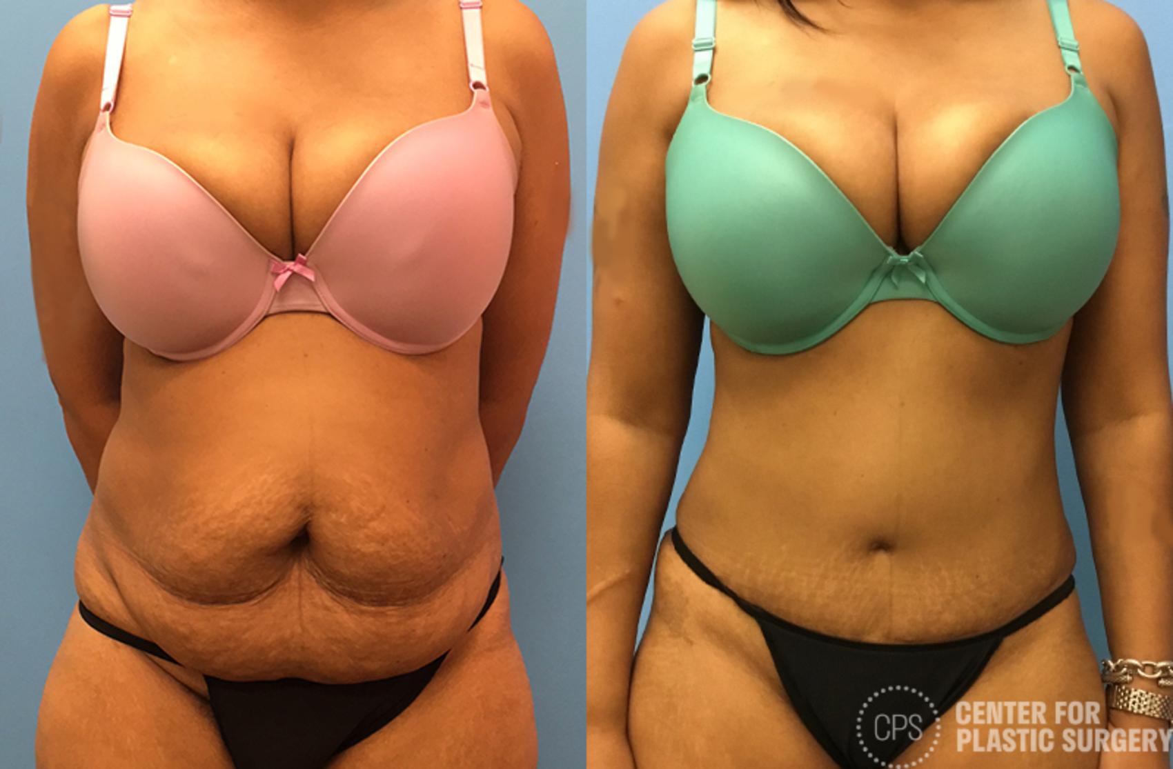 Tummy Tuck Case 48 Before & After Front | Chevy Chase & Annandale, Washington D.C. Metropolitan Area | Center for Plastic Surgery