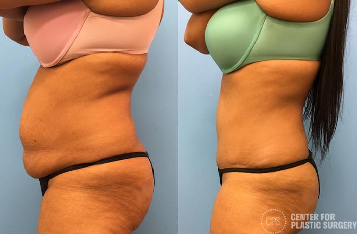 Tummy Tuck Case 48 Before & After Left Side | Chevy Chase & Annandale, Washington D.C. Metropolitan Area | Center for Plastic Surgery