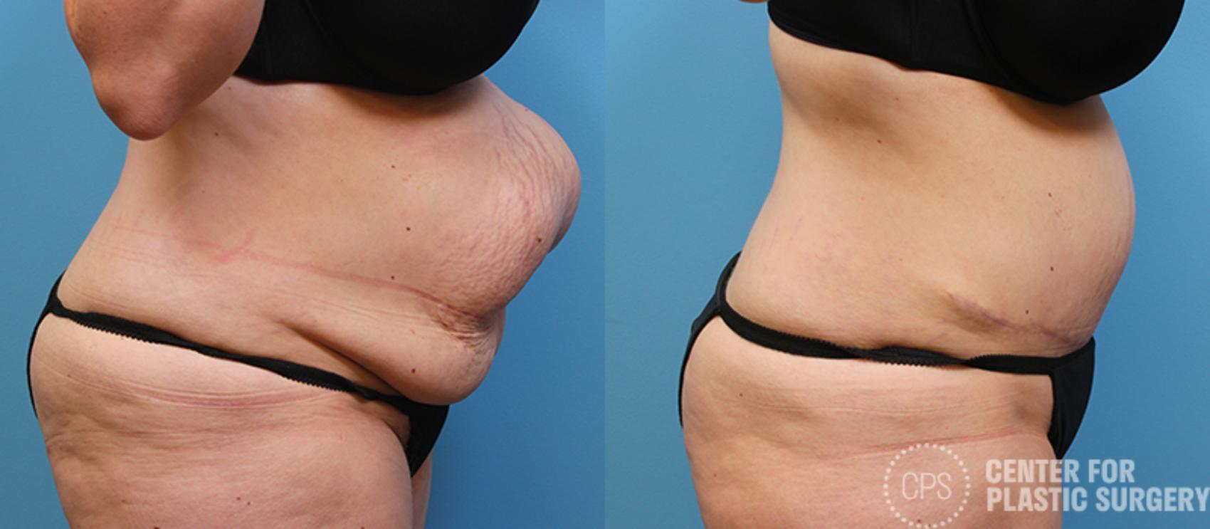 Tummy Tuck Case 49 Before & After Right Side | Annandale, Washington D.C. Metropolitan Area | Center for Plastic Surgery