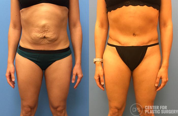 Liposuction Case 50 Before & After Front | Chevy Chase & Annandale, Washington D.C. Metropolitan Area | Center for Plastic Surgery