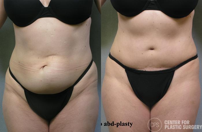 Tummy Tuck Case 51 Before & After Front | Chevy Chase & Annandale, Washington D.C. Metropolitan Area | Center for Plastic Surgery