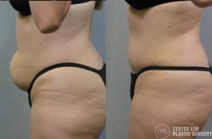Tummy Tuck Case 51 Before & After Left Side | Chevy Chase & Annandale, Washington D.C. Metropolitan Area | Center for Plastic Surgery