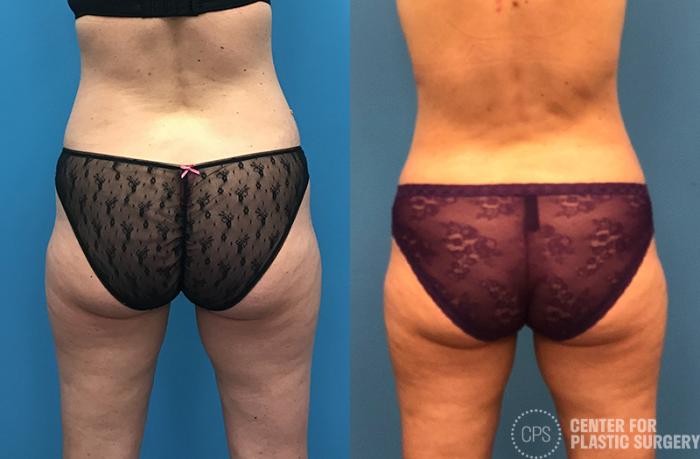 Tummy Tuck Case 52 Before & After Back | Chevy Chase & Annandale, Washington D.C. Metropolitan Area | Center for Plastic Surgery