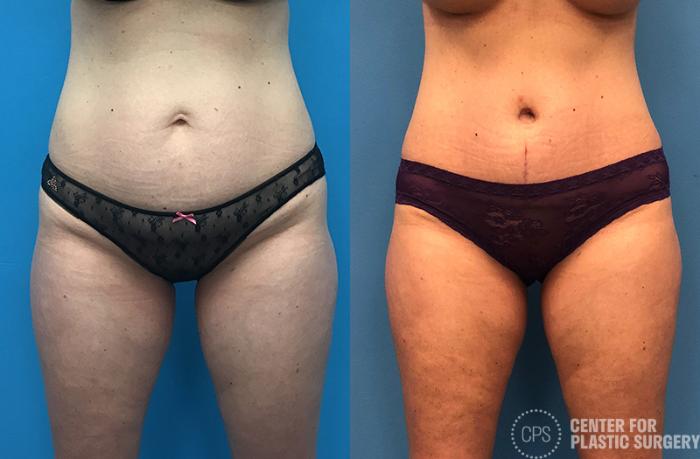 Tummy Tuck Case 52 Before & After Front | Chevy Chase & Annandale, Washington D.C. Metropolitan Area | Center for Plastic Surgery