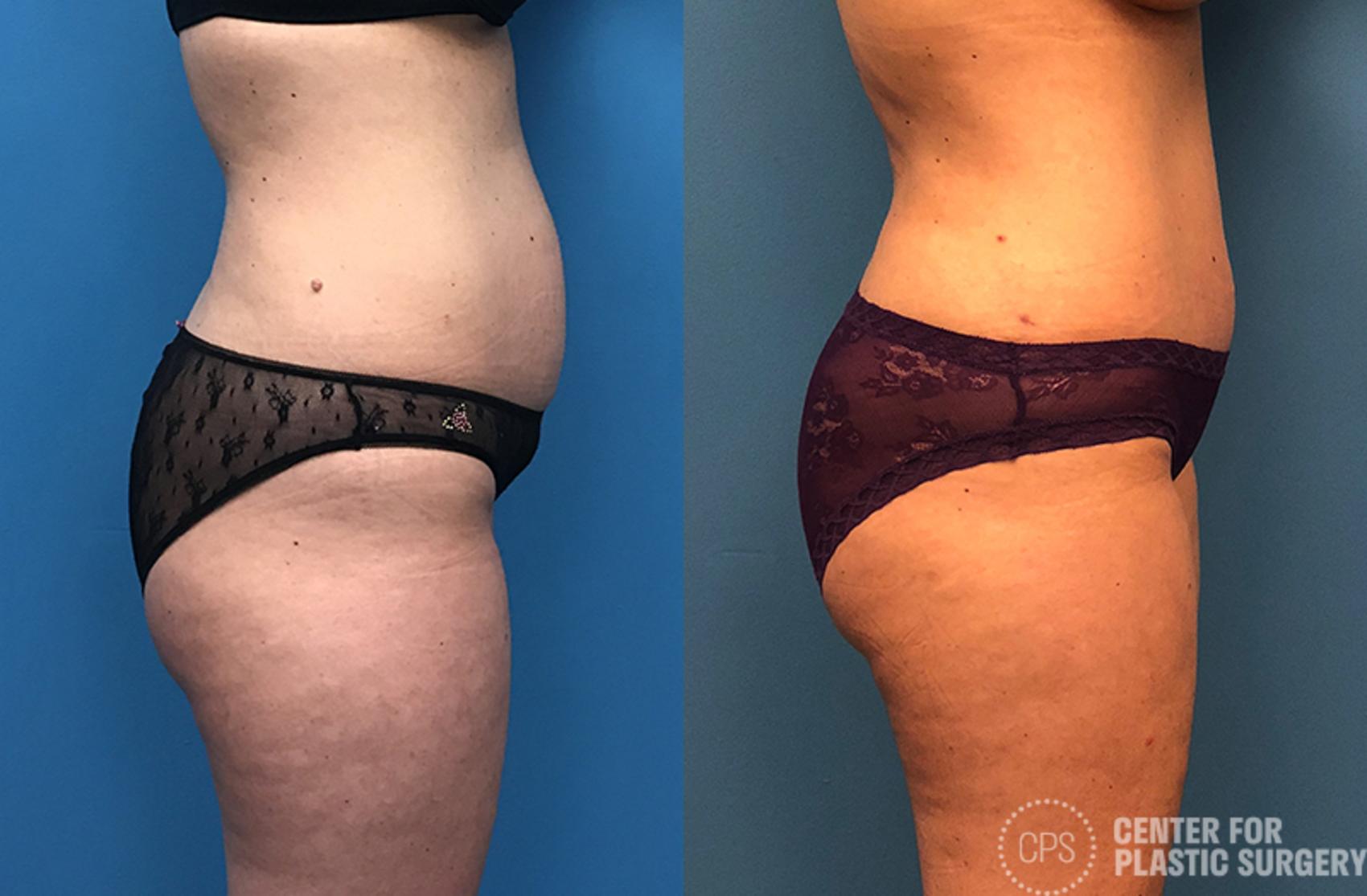 Tummy Tuck Case 52 Before & After Right Side | Annandale, Washington D.C. Metropolitan Area | Center for Plastic Surgery