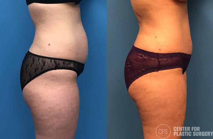 Tummy Tuck Case 52 Before & After Right Side | Chevy Chase & Annandale, Washington D.C. Metropolitan Area | Center for Plastic Surgery