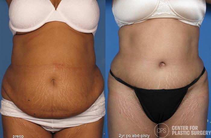 Tummy Tuck Case 53 Before & After Front | Chevy Chase & Annandale, Washington D.C. Metropolitan Area | Center for Plastic Surgery