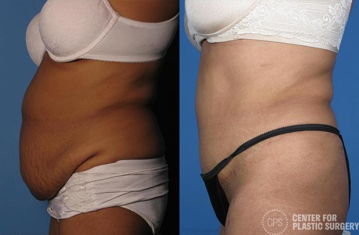 Liposuction Case 53 Before & After Left Side | Chevy Chase & Annandale, Washington D.C. Metropolitan Area | Center for Plastic Surgery