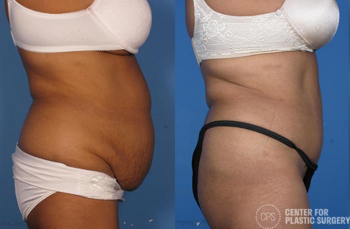 Liposuction Case 53 Before & After Right Side | Chevy Chase & Annandale, Washington D.C. Metropolitan Area | Center for Plastic Surgery