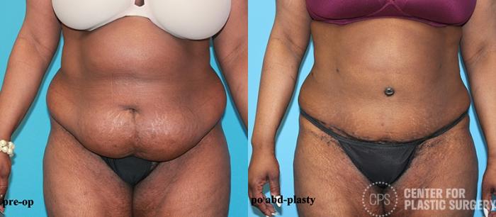 Tummy Tuck Case 54 Before & After Front | Chevy Chase & Annandale, Washington D.C. Metropolitan Area | Center for Plastic Surgery