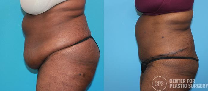 Liposuction Case 54 Before & After Left Side | Chevy Chase & Annandale, Washington D.C. Metropolitan Area | Center for Plastic Surgery