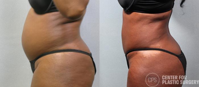 Liposuction Case 55 Before & After Left Side | Chevy Chase & Annandale, Washington D.C. Metropolitan Area | Center for Plastic Surgery