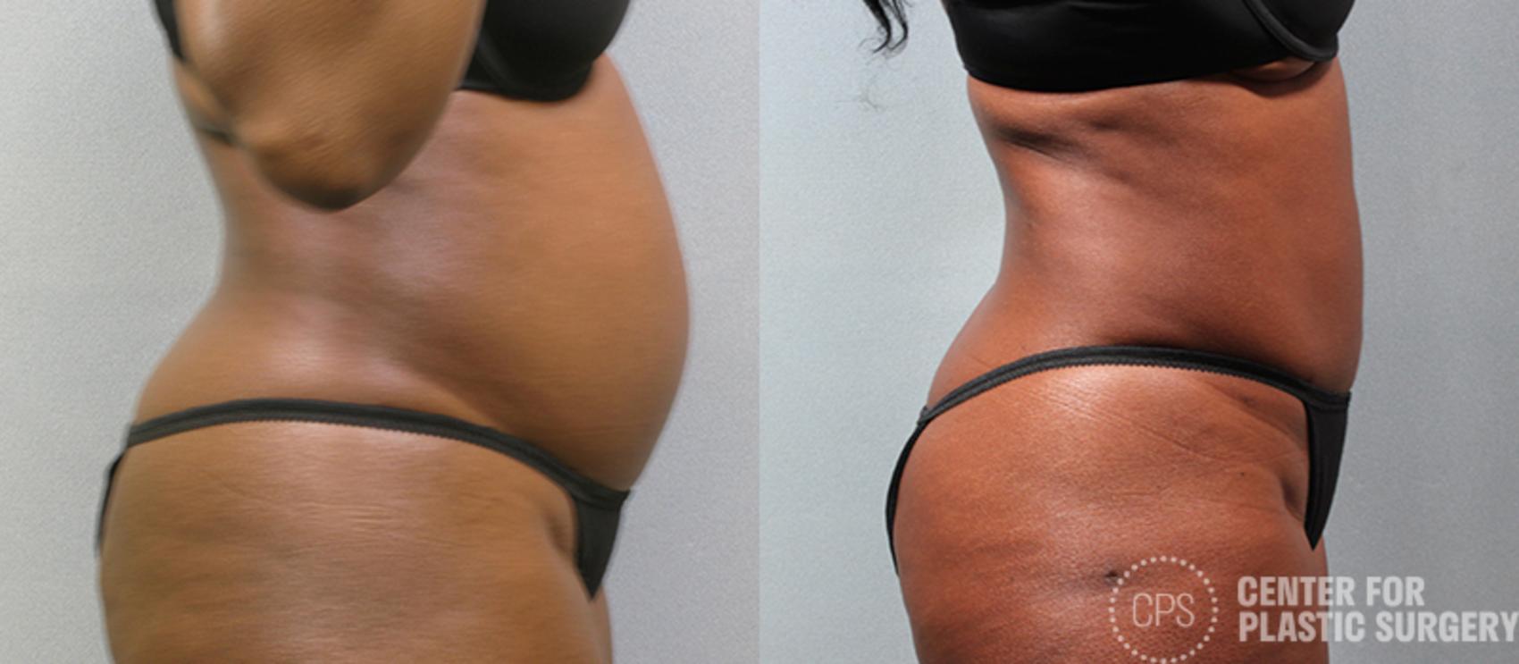 Tummy Tuck Case 55 Before & After Right Side | Annandale, Washington D.C. Metropolitan Area | Center for Plastic Surgery