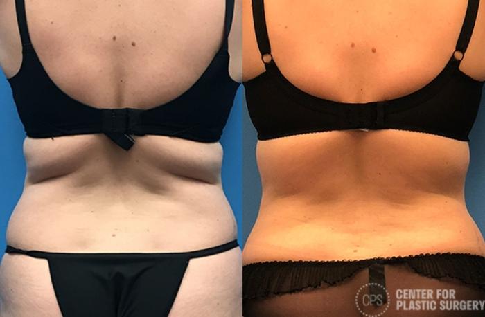 Liposuction Case 56 Before & After Back | Chevy Chase & Annandale, Washington D.C. Metropolitan Area | Center for Plastic Surgery
