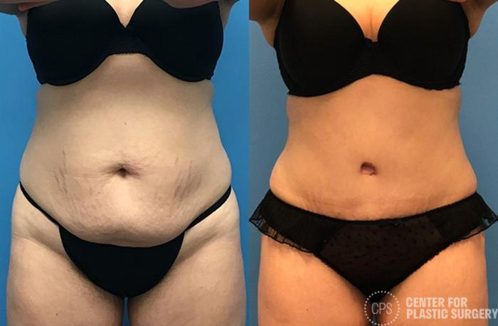 Tummy Tuck Case 56 Before & After Front | Chevy Chase & Annandale, Washington D.C. Metropolitan Area | Center for Plastic Surgery