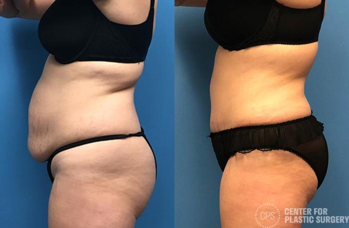 Tummy Tuck Case 56 Before & After Left Side | Chevy Chase & Annandale, Washington D.C. Metropolitan Area | Center for Plastic Surgery