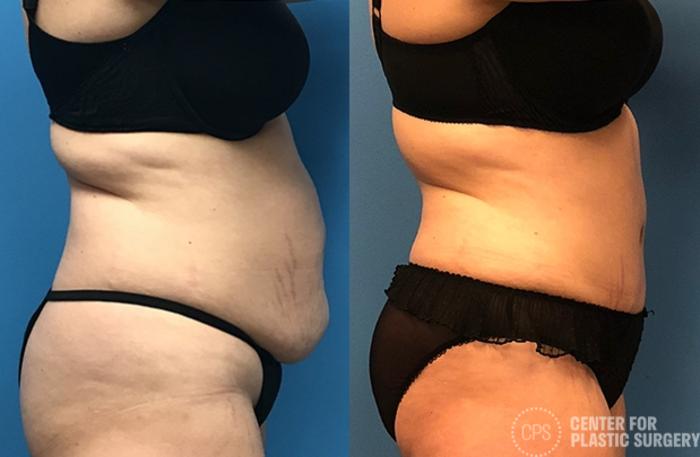 Tummy Tuck Case 56 Before & After Right Side | Chevy Chase & Annandale, Washington D.C. Metropolitan Area | Center for Plastic Surgery