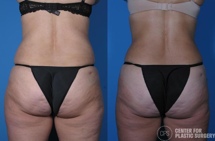 Tummy Tuck Case 57 Before & After Back | Chevy Chase & Annandale, Washington D.C. Metropolitan Area | Center for Plastic Surgery