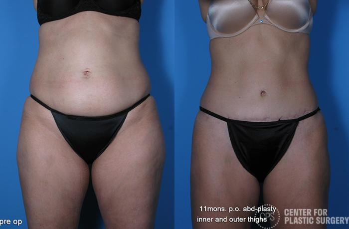 Tummy Tuck Case 57 Before & After Front | Chevy Chase & Annandale, Washington D.C. Metropolitan Area | Center for Plastic Surgery