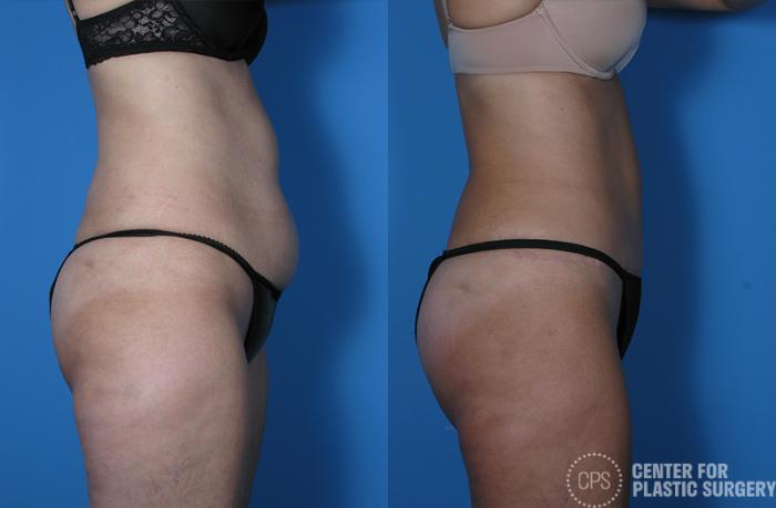 Tummy Tuck Case 57 Before & After Right Side | Chevy Chase & Annandale, Washington D.C. Metropolitan Area | Center for Plastic Surgery