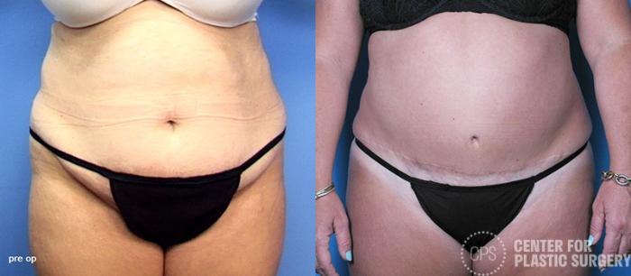 Tummy Tuck Case 58 Before & After Front | Chevy Chase & Annandale, Washington D.C. Metropolitan Area | Center for Plastic Surgery