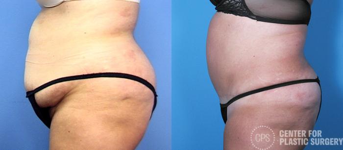 Tummy Tuck Case 58 Before & After Left Side | Chevy Chase & Annandale, Washington D.C. Metropolitan Area | Center for Plastic Surgery