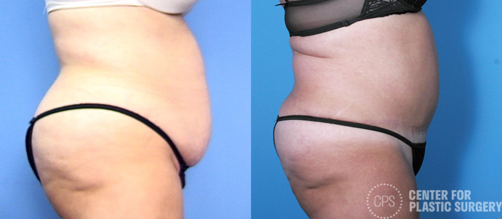 Tummy Tuck Case 58 Before & After Right Side | Annandale, Washington D.C. Metropolitan Area | Center for Plastic Surgery
