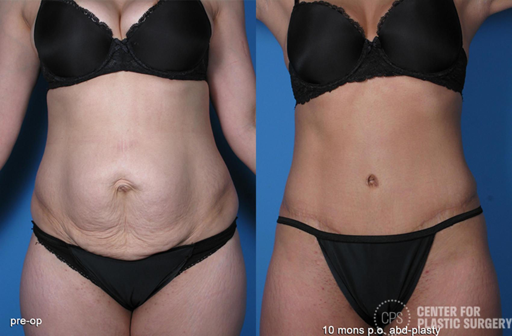 Tummy Tuck Case 60 Before & After Front | Chevy Chase & Annandale, Washington D.C. Metropolitan Area | Center for Plastic Surgery