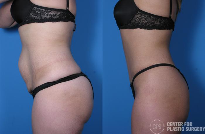 Tummy Tuck Case 60 Before & After Left Side | Chevy Chase & Annandale, Washington D.C. Metropolitan Area | Center for Plastic Surgery