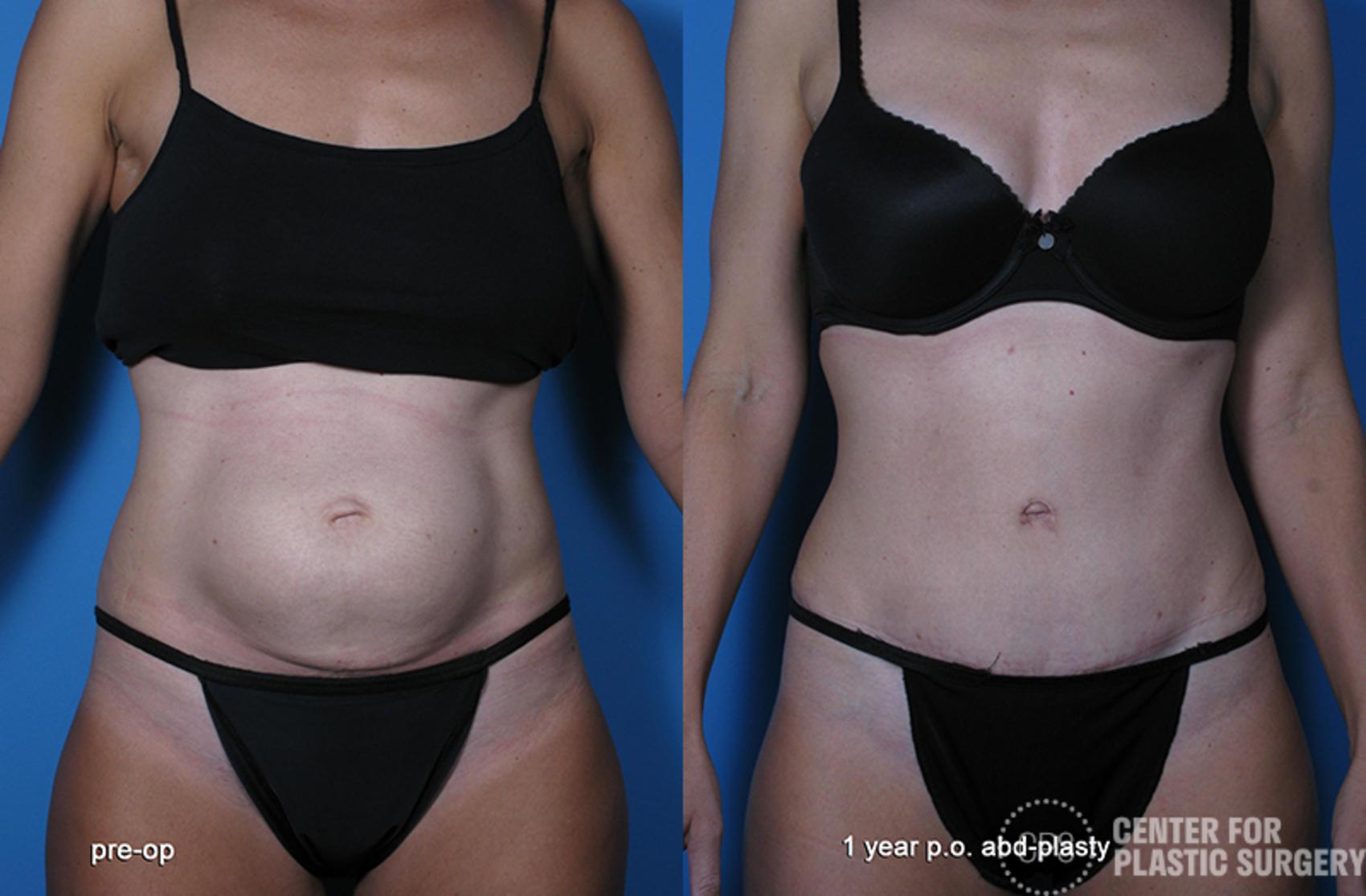 Tummy Tuck Case 61 Before & After Front | Chevy Chase & Annandale, Washington D.C. Metropolitan Area | Center for Plastic Surgery