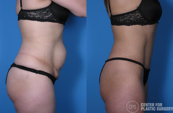 Tummy Tuck Case 61 Before & After Right Side | Chevy Chase & Annandale, Washington D.C. Metropolitan Area | Center for Plastic Surgery