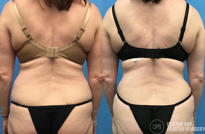 Tummy Tuck Case 63 Before & After Back | Chevy Chase & Annandale, Washington D.C. Metropolitan Area | Center for Plastic Surgery