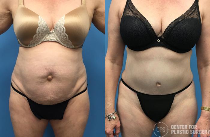 Tummy Tuck Case 63 Before & After Front | Chevy Chase & Annandale, Washington D.C. Metropolitan Area | Center for Plastic Surgery
