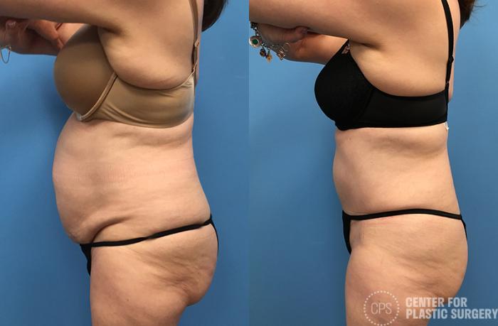 Tummy Tuck Case 63 Before & After Left Side | Chevy Chase & Annandale, Washington D.C. Metropolitan Area | Center for Plastic Surgery