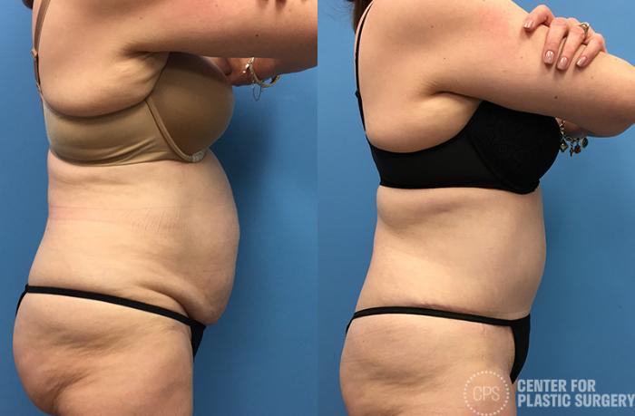 Tummy Tuck Case 63 Before & After Right Side | Chevy Chase & Annandale, Washington D.C. Metropolitan Area | Center for Plastic Surgery
