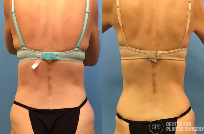 Tummy Tuck Case 64 Before & After Back | Chevy Chase & Annandale, Washington D.C. Metropolitan Area | Center for Plastic Surgery