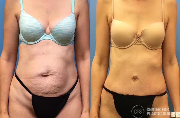 Tummy Tuck Case 64 Before & After Front | Chevy Chase & Annandale, Washington D.C. Metropolitan Area | Center for Plastic Surgery