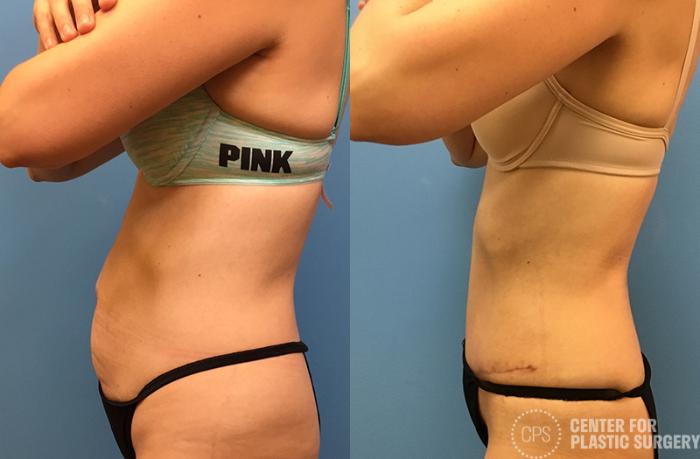 Tummy Tuck Case 64 Before & After Left Side | Chevy Chase & Annandale, Washington D.C. Metropolitan Area | Center for Plastic Surgery