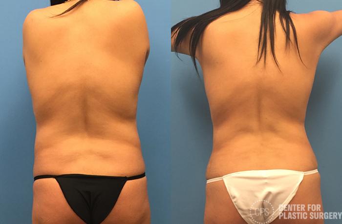 Liposuction Case 65 Before & After Back | Chevy Chase & Annandale, Washington D.C. Metropolitan Area | Center for Plastic Surgery