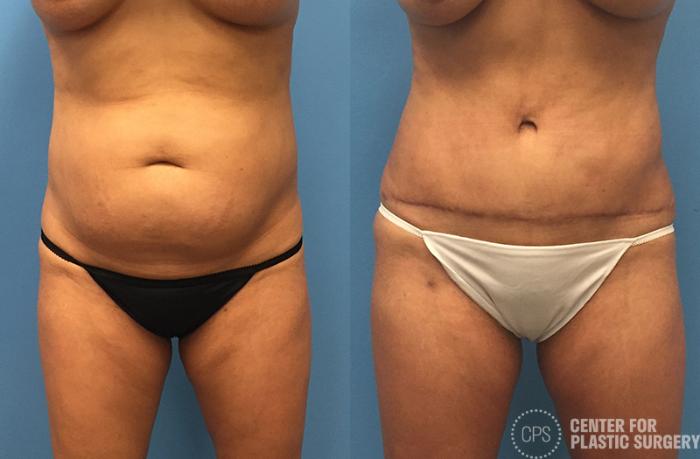 Tummy Tuck Case 65 Before & After Front | Chevy Chase & Annandale, Washington D.C. Metropolitan Area | Center for Plastic Surgery