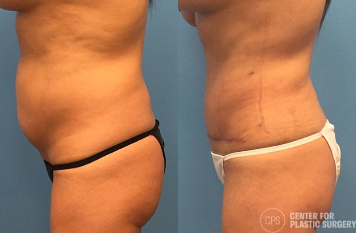 Liposuction Case 65 Before & After Left Side | Chevy Chase & Annandale, Washington D.C. Metropolitan Area | Center for Plastic Surgery